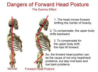 Neck pain forward head posture