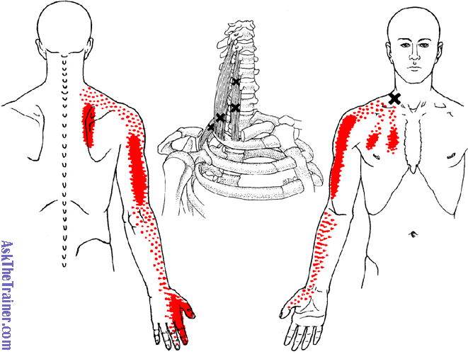 scalene-muscles-trigger-points