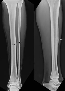 Return to Running after a Tibial Stress Fracture